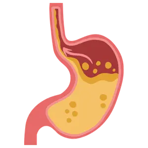 Inicio cirugía anti reflujo