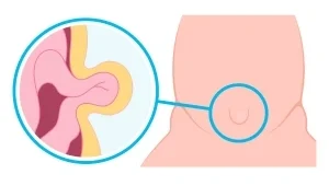 Cirugía de Hernias en Playa del Carmen