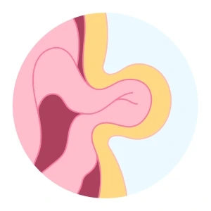 Cirugía de Hernias en Playa del Carmen