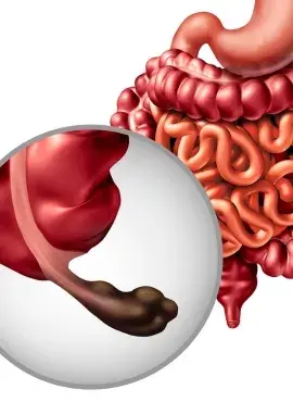 Apendicetomía en Playa del Carmen