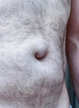 Cirugía de Hernia Umbilical en Playa del Carmen