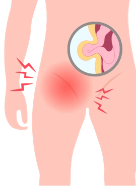 Cirugía de Hernia Inguinal en Playa del Carmen