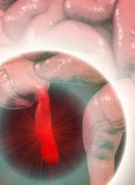 Apendicetomía en Playa del Carmen