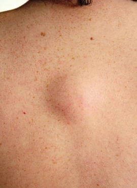 Cirugía de Lipomas en Playa del Carmen