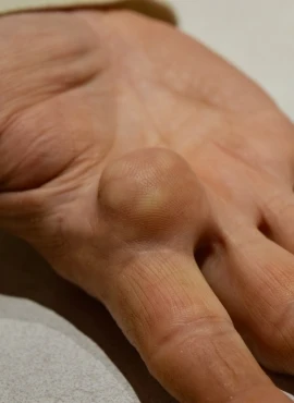 Cirugía de Lipomas en Playa del Carmen