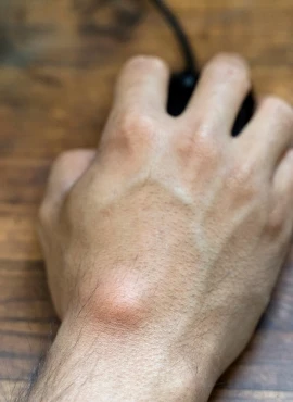 Cirugía de Lipomas en Playa del Carmen